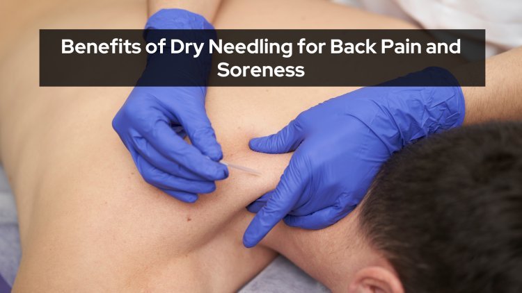 Benefits of Dry Needling for Back Pain and Soreness