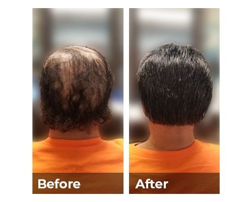 What Is The Difference Between Surgical And Non-Surgical Hair Restoration?