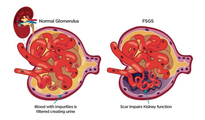Focal Segmental Glomerulosclerosis (FSGS) Treatment Market Size, Share, Trends, Growth, Analysis, Report and Forecast 2024-2032
