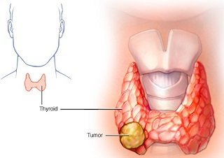Thyroid Ablation Treatment In India
