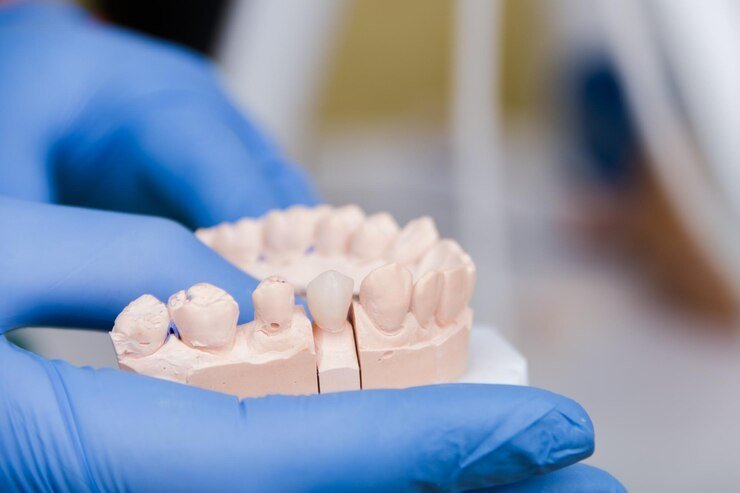 Dental Bridges - Costs, Uses, and Procedure