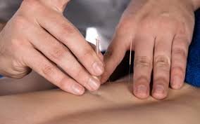 Unlock the Benefits of Dry Needling Physiotherapy in Abbotsford
