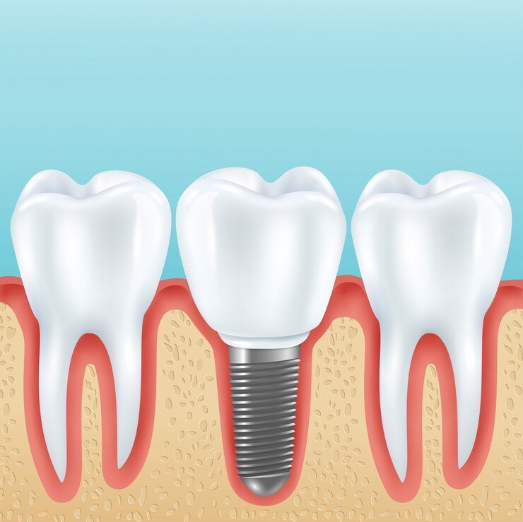 Regain Your Smile and Confidence with Dental Implants in Sandestin, FL