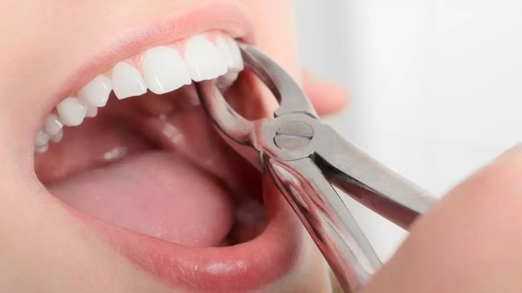 Tooth Extraction Orlando: Relief for Damaged Teeth
