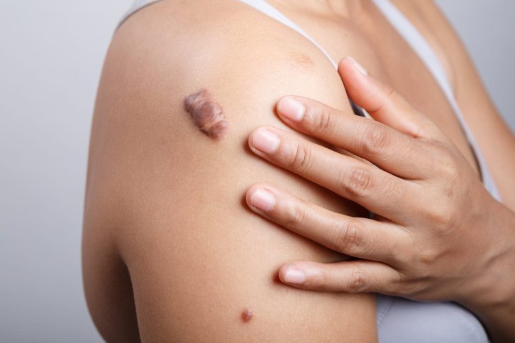 Mole Removal Myths Debunked: What You Need to Know!