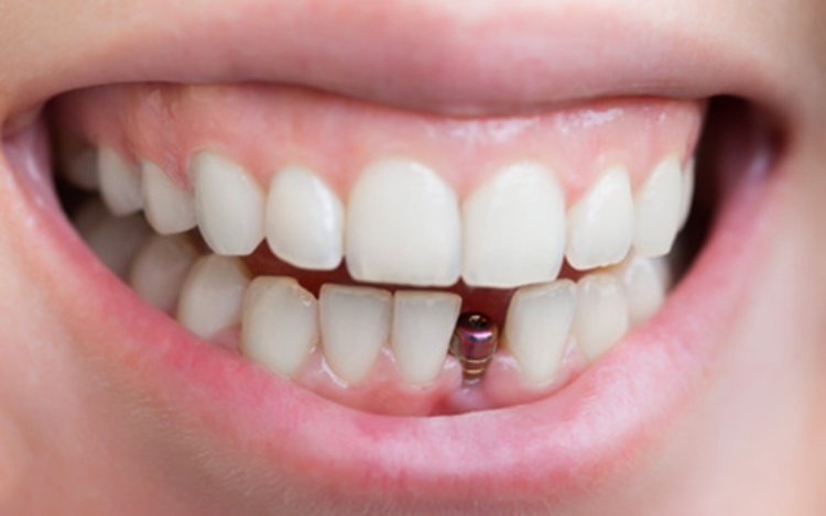 What is a Single Tooth Implant?