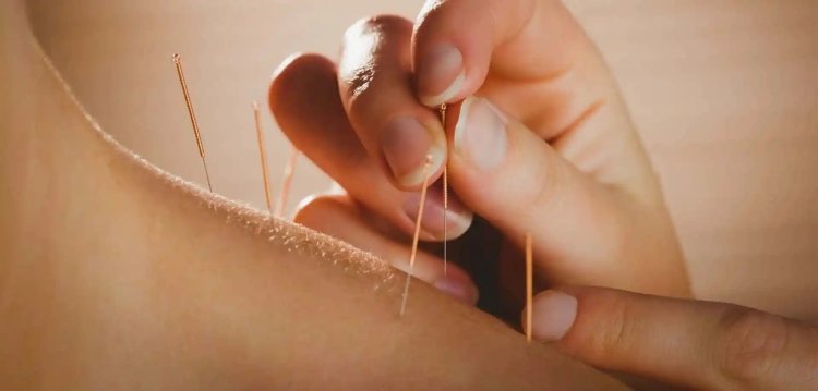 How Acupuncture Treats Neck Pain: An In-Depth Guide for Orange County Residents