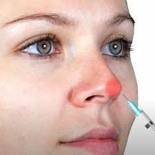 Ideal age for nose bump filler