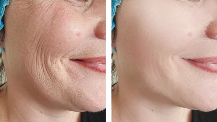 What Determines the Cost of Forma Skin Tightening? Key Factors Explained