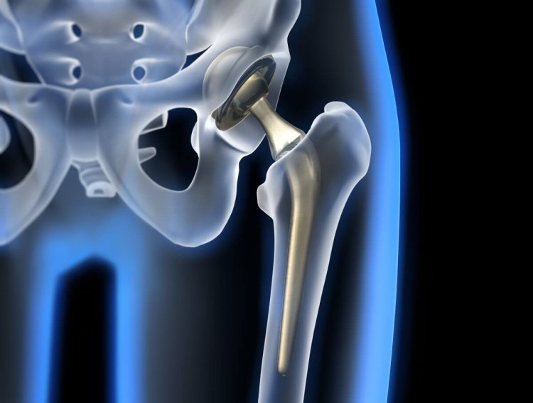 Hip Implants market Key Details and Outlook by Top Companies Till 2030