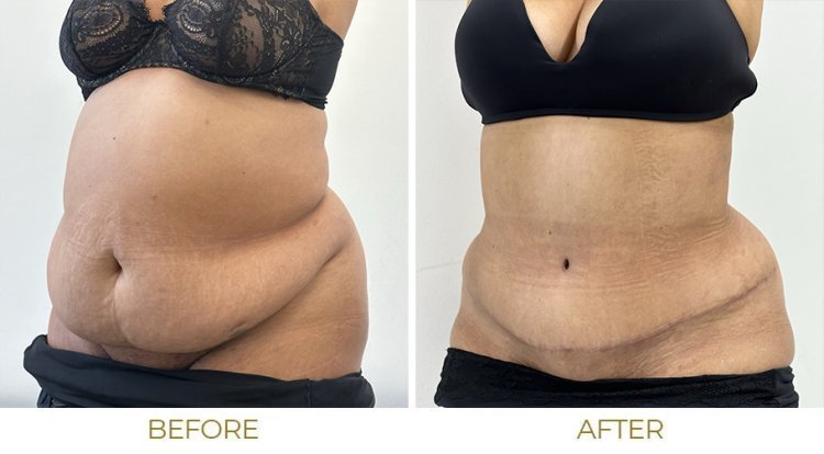 The Benefits of Tummy Tuck Surgery: Achieving a Flatter, Firmer Midsection