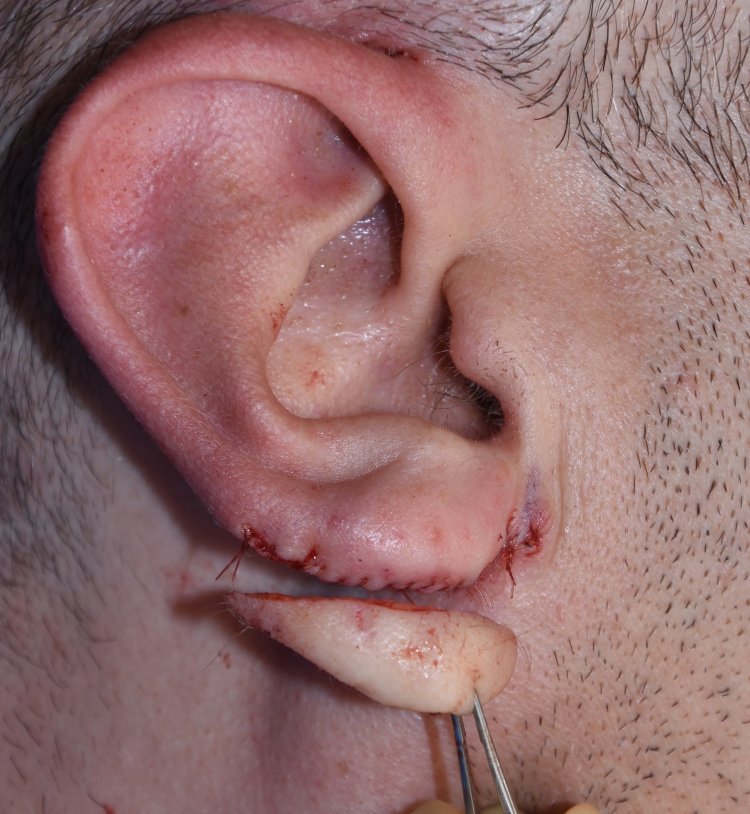 Craft Your Perfect Look: Earlobe Plastic Surgery Options in Riyadh