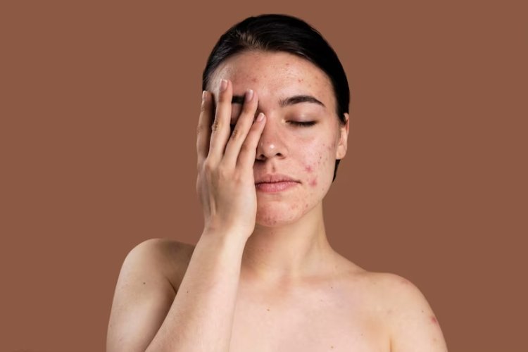 Acne Scar Treatments for Clear Skin at Estique Skin & Hair Clinic