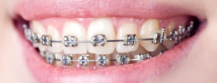 Understanding Dental Braces Costs in Dubai  A Comprehensive Guide