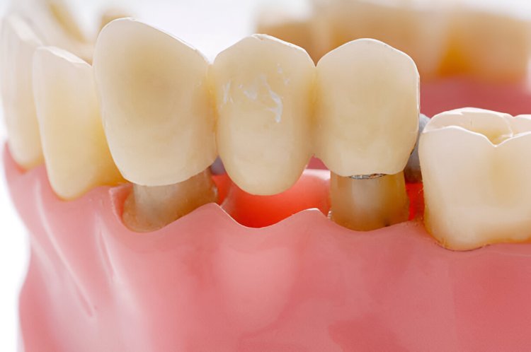 High-Quality Dental Bridges at Branson Family Dental in Branson, MO