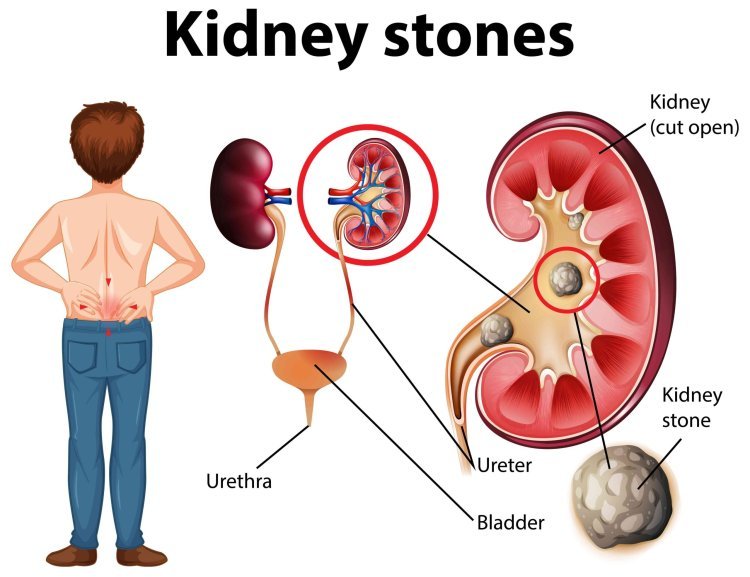 Possible Ayurvedic Remedies for Kidney Stones: Insights from Aksa Ayurveda