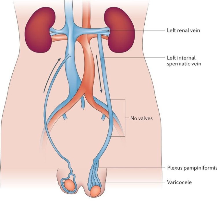 Varicocele Embolisation: A Minimally Invasive Treatment for Varicoceles