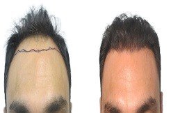 ????‍♂️ زراعة الشعر في دبي: كل ما يجب أن تعرفه قبل اتخاذ القرار ????