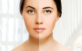 Is Skin Whitening Treatment in Dubai Right for You?