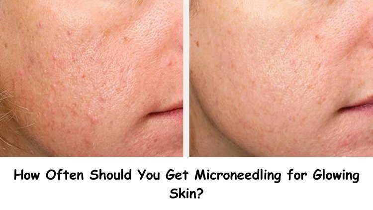 How Often Should You Get Microneedling for Glowing Skin?