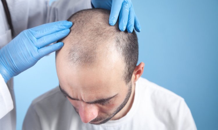 Can a Hair Transplant Help with Receding Hairlines?